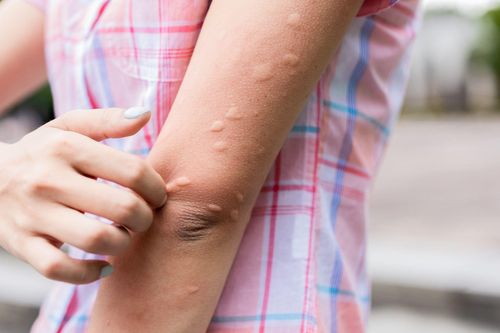 Mề đay mãn tính vào mùa hè: Kiểm soát bằng cách nào?