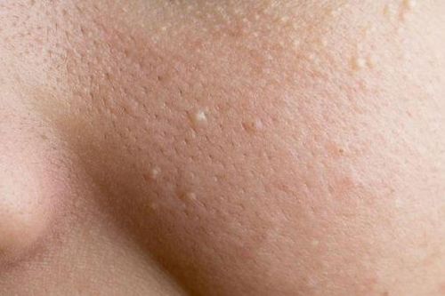 2 cách trị mụn đầu trắng bạn chưa biết