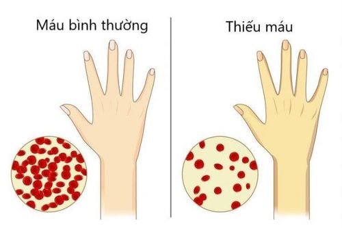 Cách lựa chọn thuốc bổ máu phù hợp