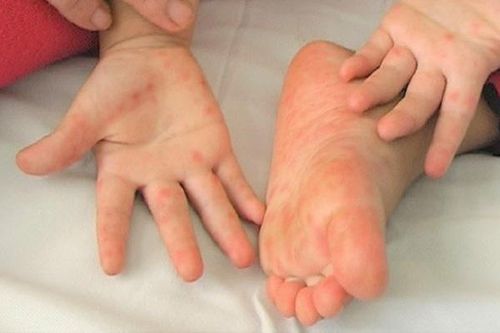 Chủ động phòng, chống dịch tay chân miệng