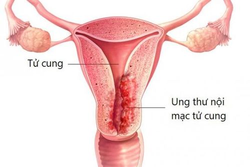 Bất lợi qua trung gian miễn dịch của thuốc trị ung thư nội mạc tử cung