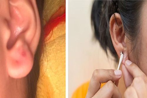 Thiếu nữ nhập viện vì biến chứng sau bấm lỗ tai