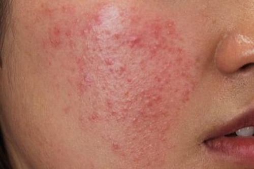 Nhận biết dị ứng mỹ phẩm