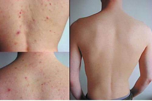 4 điều cần ghi nhớ để có thể hết mụn ở lưng