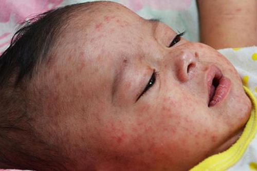 Dấu hiệu nhận biết Rubella giai đoạn phát bệnh