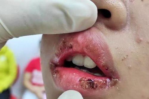 Hậu quả nặng nề vì dùng mỹ phẩm trôi nổi