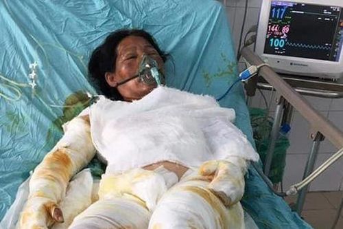 Chồng bị thần kinh, vợ đang nguy kịch vì bỏng nặng rất cần sự giúp đỡ