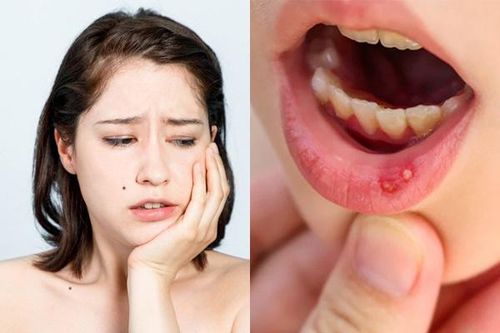 Cách điều trị nhiệt miệng tận gốc, không lo tái lại
