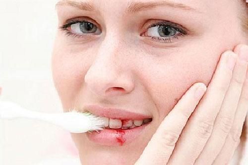 Chảy máu chân răng là dấu hiệu nhiều bệnh nguy hiểm