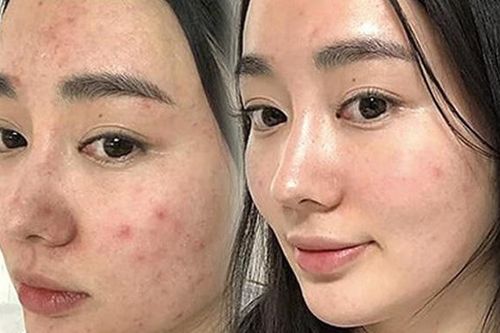 Hiểu về thành phần dưỡng trắng, trị thâm để không bị 'dắt mũi' khi mua mỹ phẩm