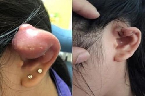 Mưng mủ vì bấm lỗ tai không bảo đảm vô trùng