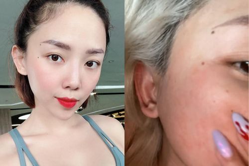 Vì sao Tóc Tiên bị mẩn đỏ khi dùng retinol?