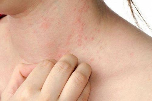 Các loại vitamin tốt cho người bệnh Rubella