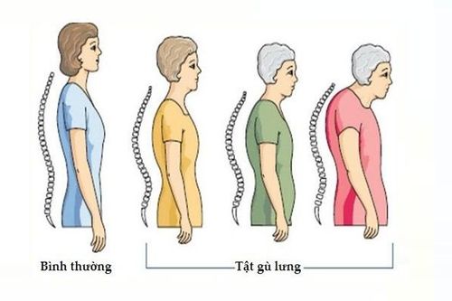 Cách phòng ngừa chứng gù lưng ở người cao tuổi
