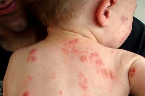 Bệnh ngoài da tăng do nắng nóng