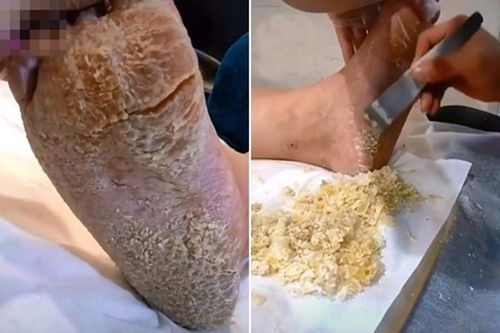Chuyên gia làm đẹp hết hồn với bàn chân như 'người đất' của khách hàng