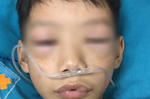 Uống thuốc tự mua, bé 10 tuổi ở Phú Thọ bị sốc phản vệ phải cấp cứu