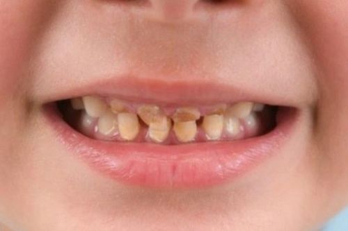 Răng sữa bị sâu, cần làm gì?