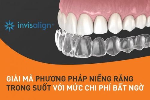 Niềng răng trong suốt Invisalign giá bao nhiêu?