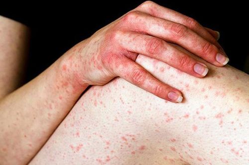 Tìm hiểu 10 bệnh ngứa ngoài da vào mùa hè thường gặp