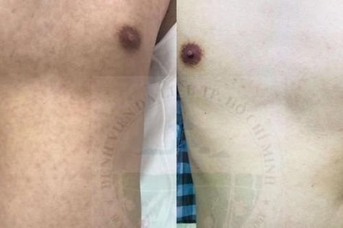 Phát hiện bệnh lý lây truyền qua đường tình dục hiếm gặp