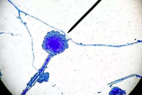 Chưa hết bàng hoàng vì Covid-19, Ấn Độ lại bị bệnh nấm đen chết người 'tấn công'