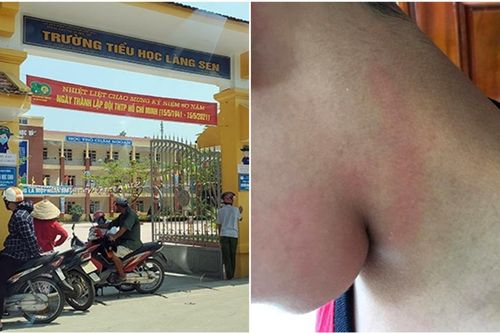 Con ở lớp bị bạn cắn vào tay, mẹ tìm đến tận nhà tát vào mặt một học sinh để 'trả đũa'