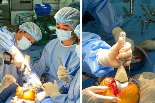 Nhập khẩu khớp gối từ Đức về cứu chân của bệnh nhân 62 tuổi