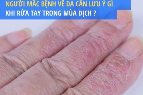 Người mắc bệnh về da cần lưu ý gì khi rửa tay trong mùa dịch?