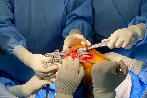 Lần đầu tiên phẫu thuật thành công thay khớp gối thì đầu, dạng bản lề tại Việt Nam
