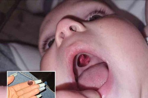 Phát hiện lỗ sâu hoắm trong miệng con, người mẹ khóc thét... và sự thật