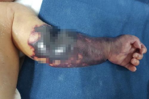 Mắc hội chứng lạ, tay bé trai 30 ngày tuổi bị hoại tử