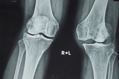 Lần đầu tại Việt Nam phẫu thuật thay khớp gối dạng bản lề bằng titanium
