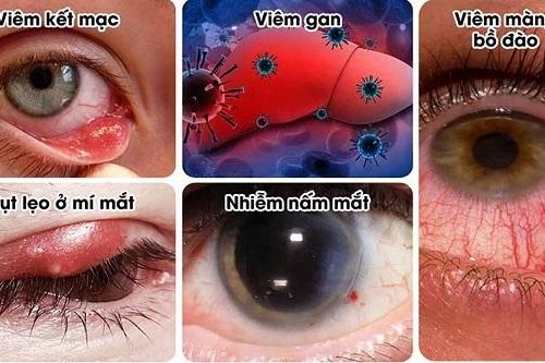 Co giật mí mắt, cảnh báo các bệnh về mắt