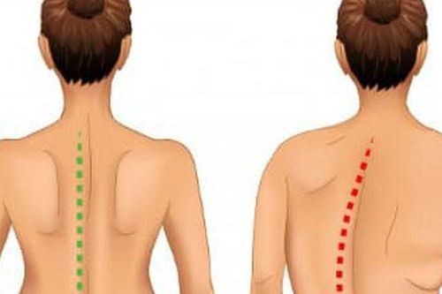 Cô gái cao thêm 20cm sau khi được bác sỹ tháo bỏ khối 'mai rùa'