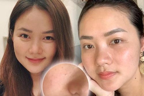 Phan Như Thảo khoe mặt mộc với làn da tàn nhang lốm đốm