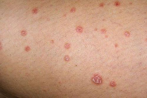Mối nguy hiểm mà bệnh lậu gây nên
