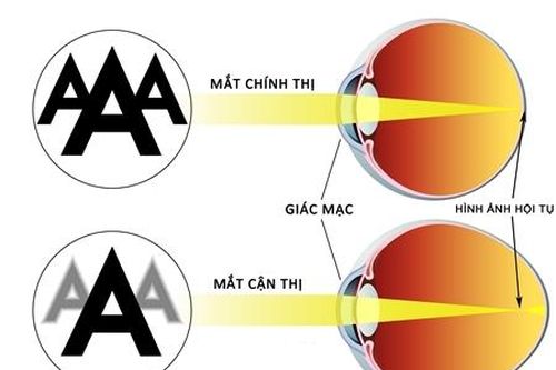 Các tật khúc xạ phổ biến ở trẻ em