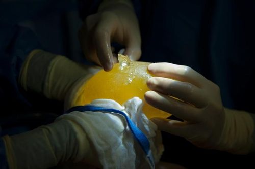 Tòa án Pháp yêu cầu bồi thường cho hàng trăm nạn nhân từng nâng ngực
