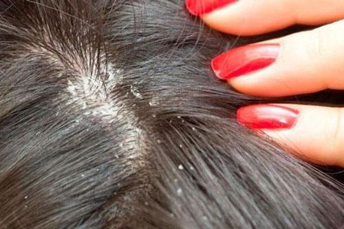 Trị gàu trong mùa hè hiệu quả với muối