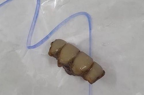Hy hữu nuốt 4 chiếc răng giả trong lúc ho