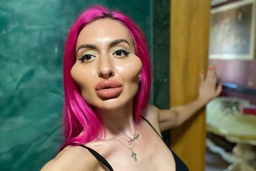 Người mẫu Ukraine nghiện tiêm filler đến biến dạng mặt