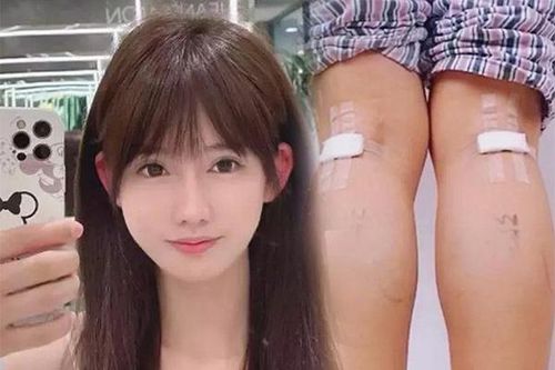 Cắt dây thần kinh để làm chân thon - phương pháp làm đẹp rùng rợn của giới trẻ
