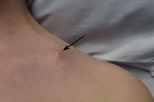 Chấn thương vai và vấn đề cần lưu ý