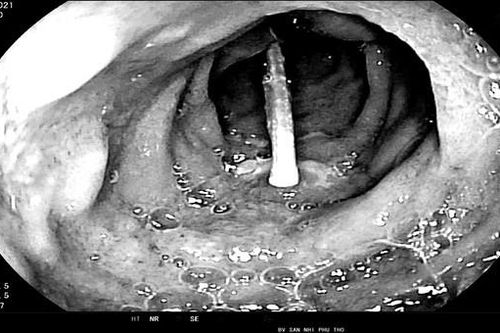 Gắp cây tăm dài 6cm từ tá tràng bé trai 3 tuổi