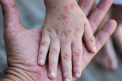 Tổng hợp các câu hỏi thường gặp về bệnh Rubella