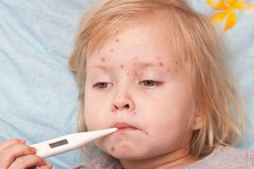 Bệnh Rubella có chữa được không? Cần hỏi gì khi gặp bác sĩ?