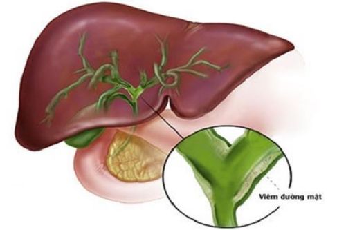 Hạn chế dùng ocaliva ở bệnh nhân viêm đường mật nguyên phát bị xơ gan tiến triển