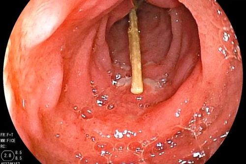 Tăm dài 6 cm trong tá tràng bé trai 3 tuổi
