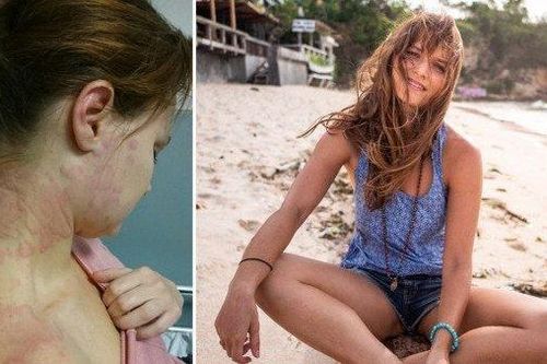 Bị dị ứng mỗi khi đi làm, cô gái quyết định bỏ việc để đi du lịch